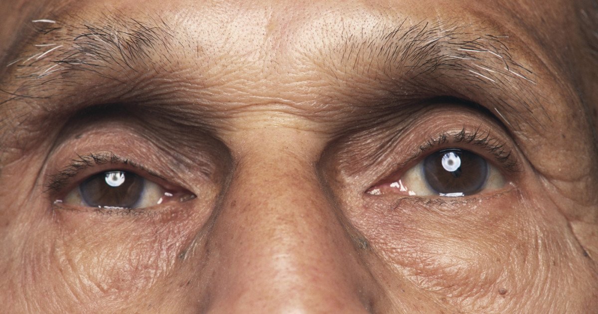 O bacterie prezentă în ochi, asociată cu boala Alzheimer și declinul cognitiv, arată un nou studiu