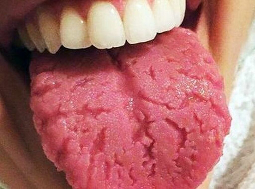 Limba crăpată: Indică o problemă de sănătate ignorată de mulți