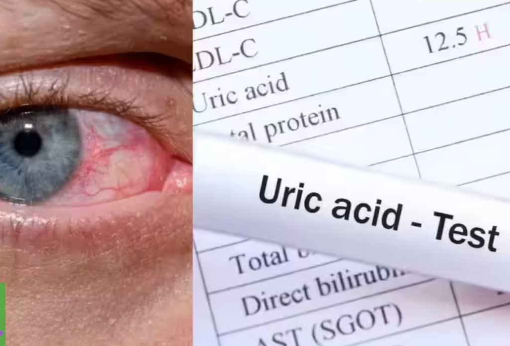 Alarmă: 10 afecțiuni medicale care cresc nivelul de acid uric în sânge
