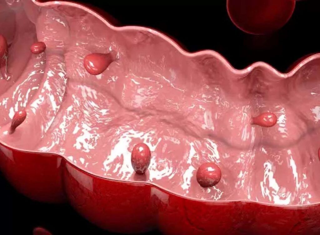 Polipii sesili: Leziunea silențioasă din colon care crește riscul de cancer