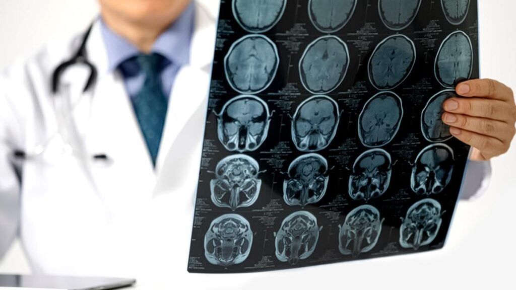 Avc: Marker sangvin mai relevant decât colesterolul, spun medicii