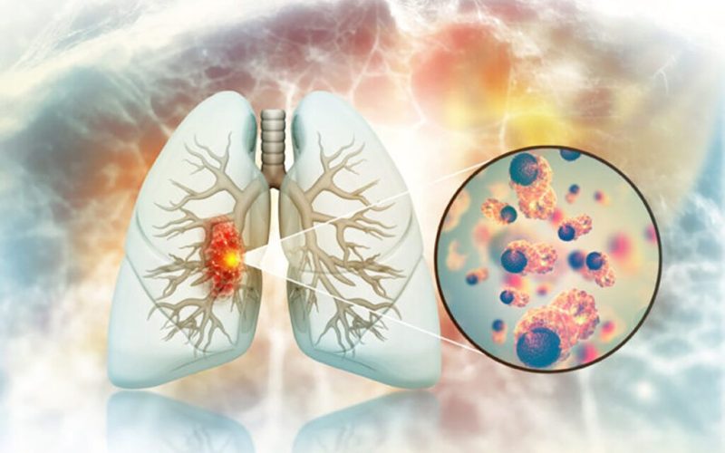 Cancerul pulmonar la nefumători: Legătură șocantă cu fructele și legumele