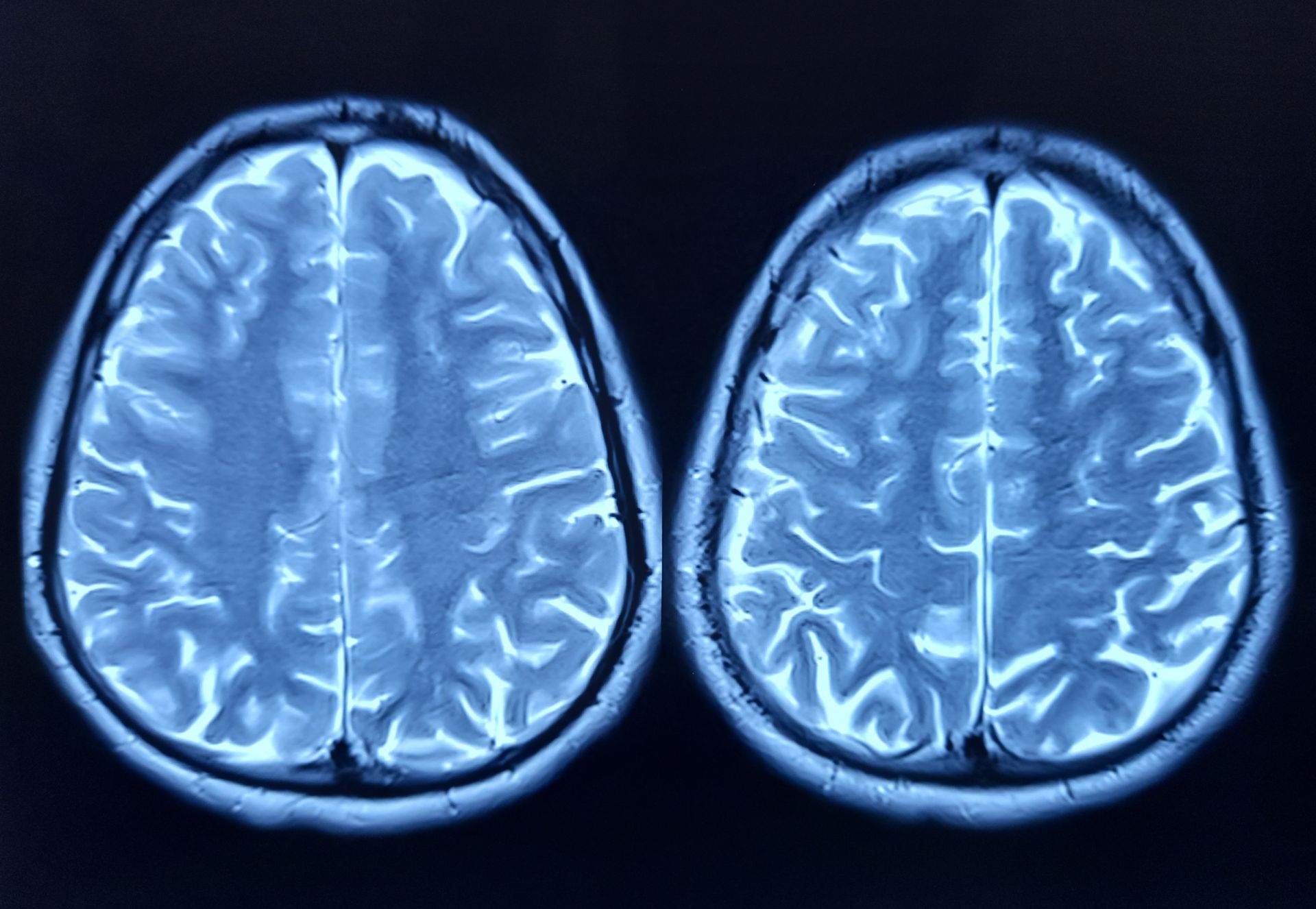 Oamenii de știință au dat verdictul: Ce grăbește îmbătrânirea creierului