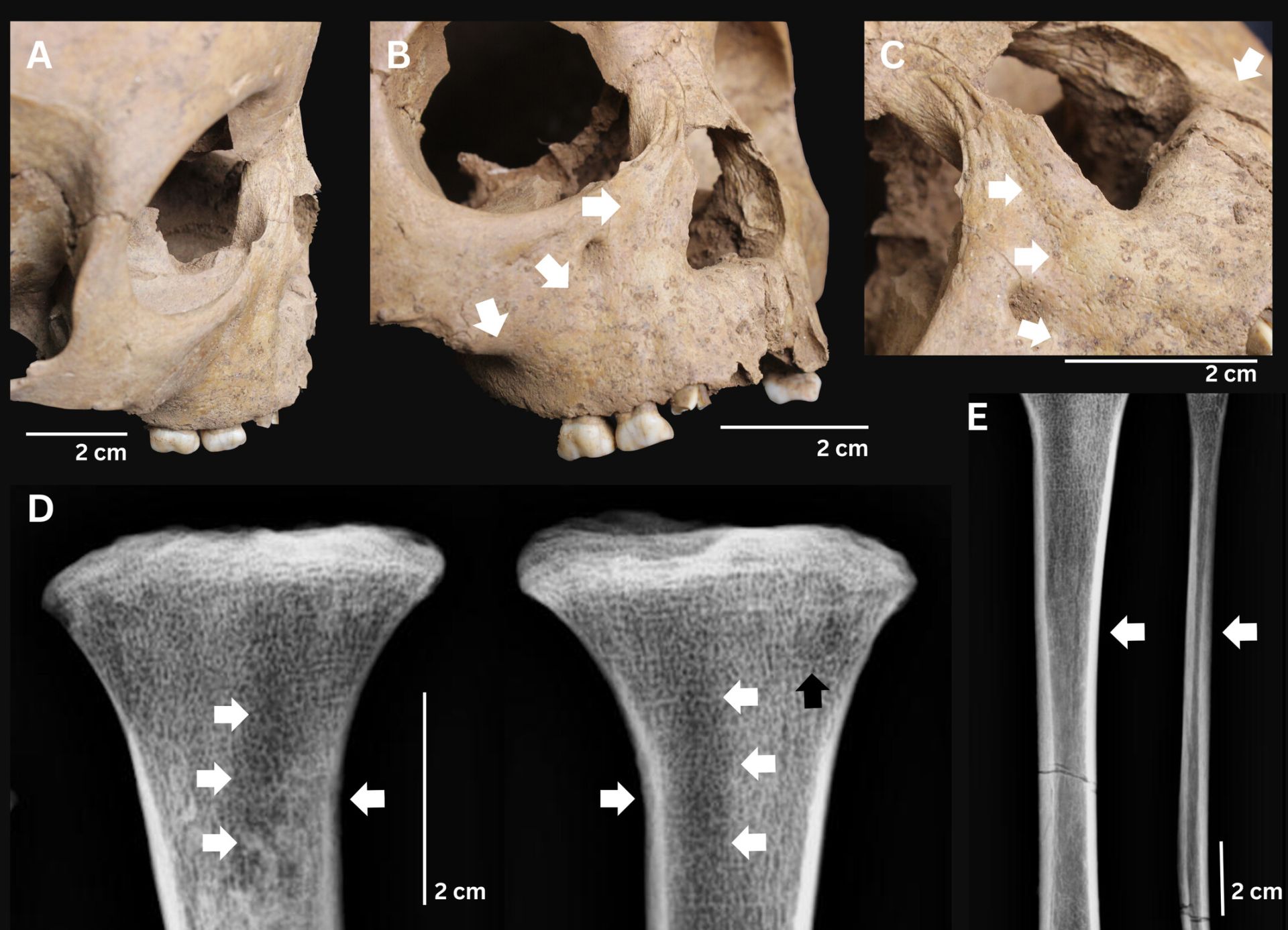 Dinți din antichitate dezvăluie boală cruntă ce făcea ravagii acum 4000 de ani