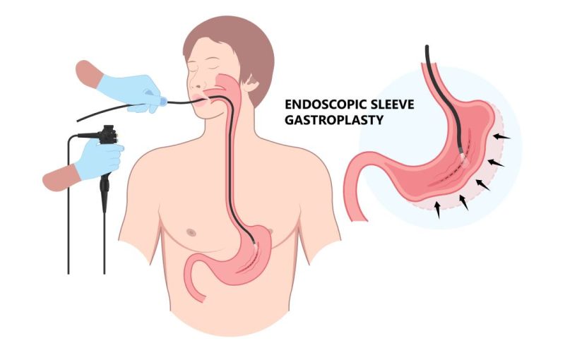 EȘECUL slăbirii? O nouă procedură endoscopică, fără operație, te scapă de kilograme
