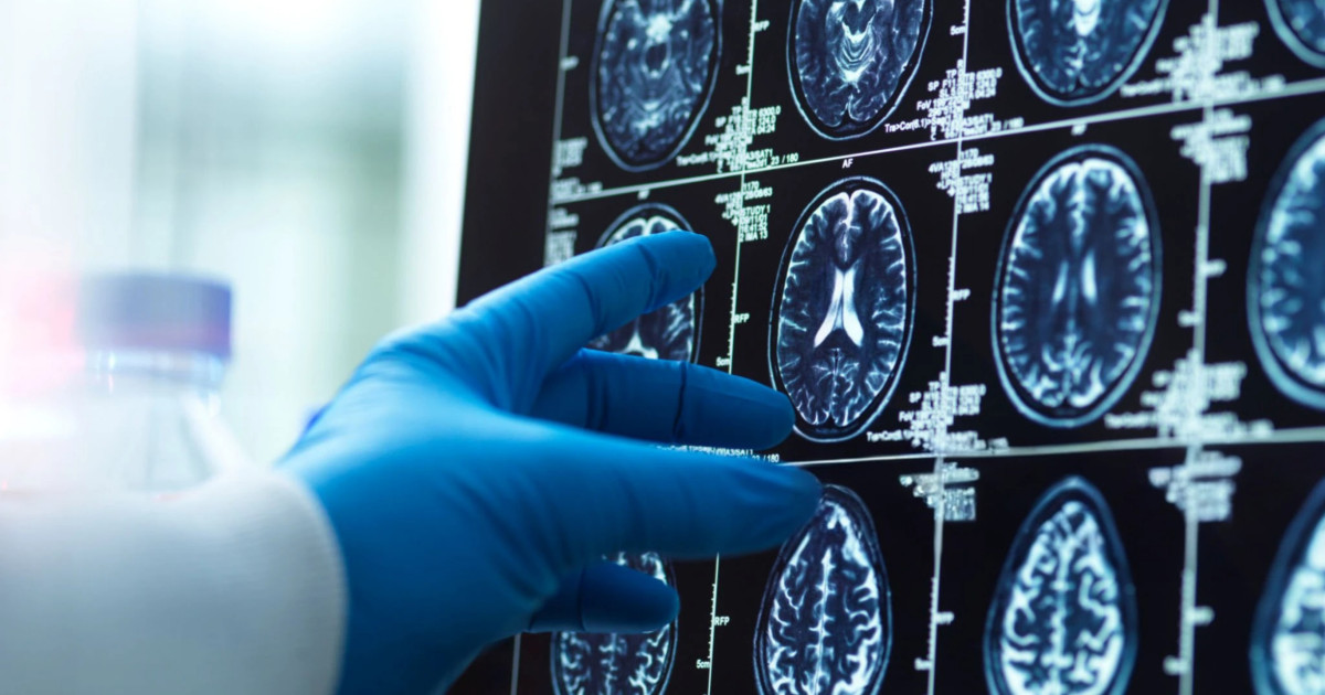 Prima hartă a creierului îmbătrânit: Zonele vulnerabile la alzheimer dezvăluite