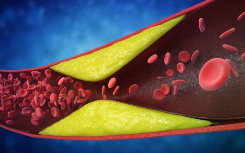 Avertisment vital: 7 semne ale arterelor blocate, ignorate adesea
