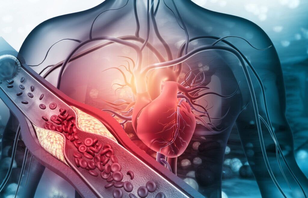 Ateroscleroza, principalul inamic al inimii, poate fi prevenită prin schimbări simple în stilul de viață