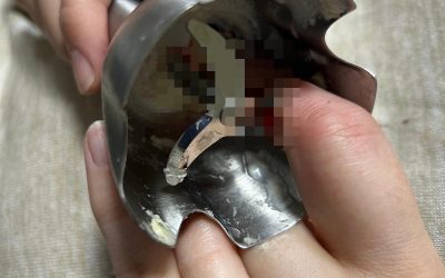 Două femei din Iași, victime ale unor accidente casnice grave, la spital