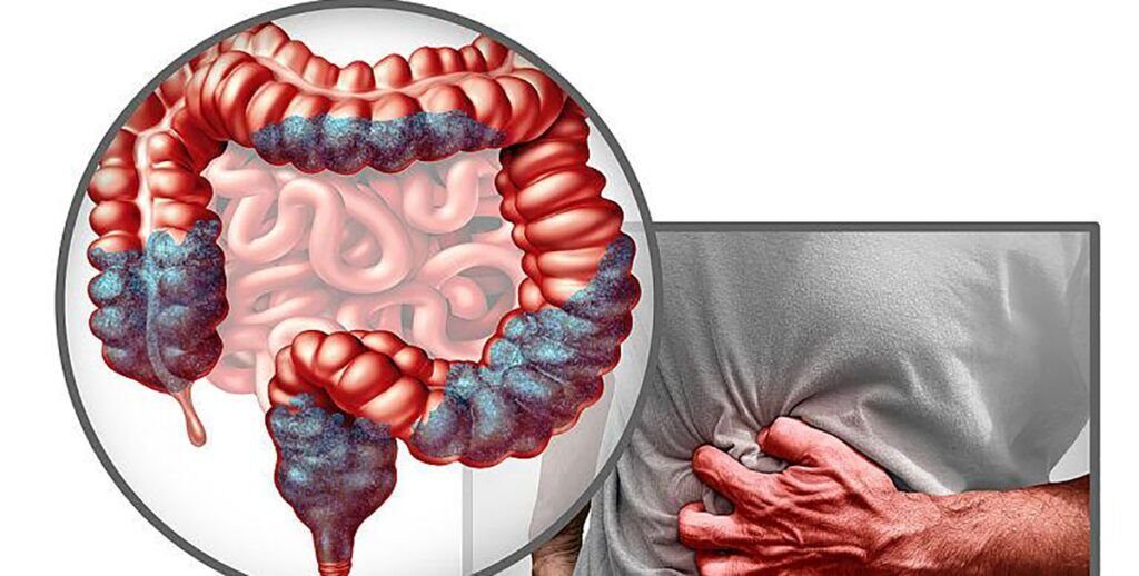Aproape jumătate dintre adulți ignoră legătura dintre consumul anumitor alimente și riscul crescut de cancer colorectal