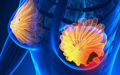 Semnele CANCERULUI la sân: 5 simptome la care trebuie să fii atentă