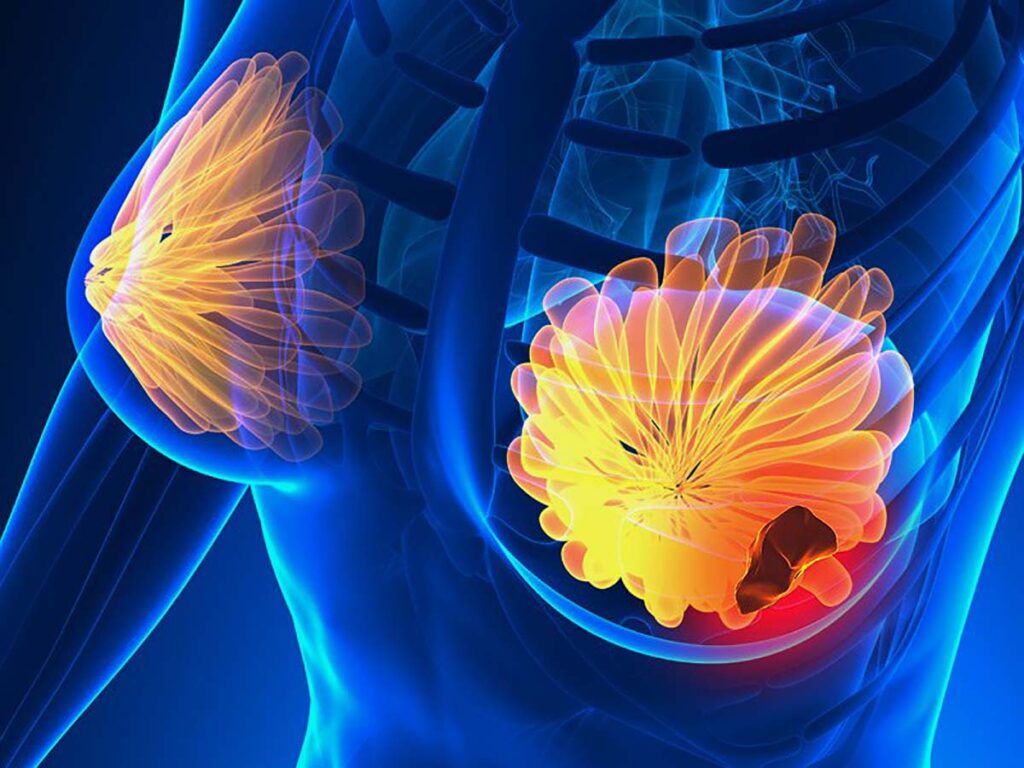 Semnele CANCERULUI la sân: 5 simptome la care trebuie să fii atentă