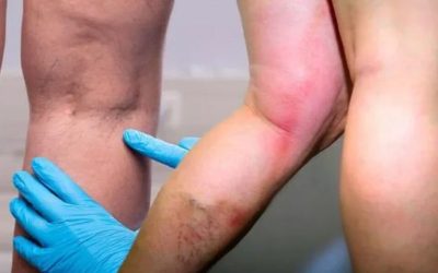 Vitamina-minune: Previne cheagurile de sânge și întărește imunitatea