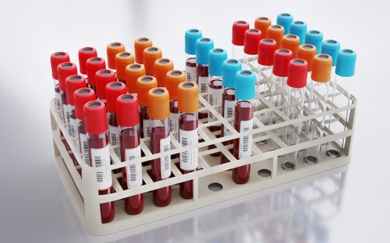 Analiză de sânge revoluționară: Prevede infarctul și AVC mai bine ca colesterolul