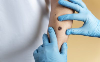 O femeie din Plymouth, Anglia, și-a pierdut viața la vârsta de 37 de ani din cauza unui cancer de piele diagnosticat tardiv, lăsând în urmă doi copii