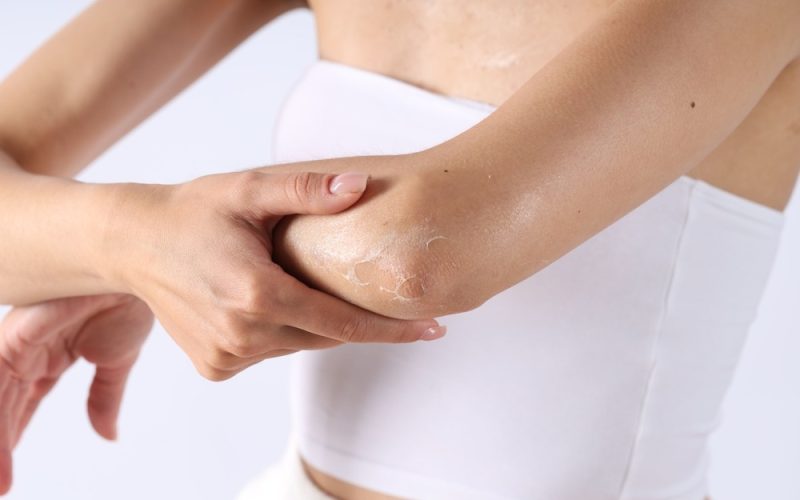 Piele uscată pe brațe și picioare? 5 obiceiuri care distrug epiderma