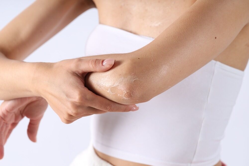 Piele uscată pe brațe și picioare? 5 obiceiuri care distrug epiderma