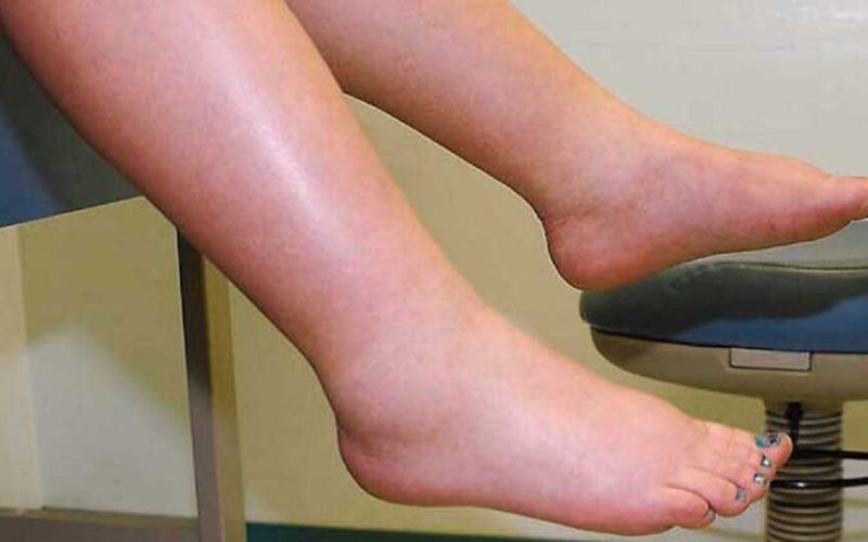 Leguma minune: Spune STOP circulației proaste și picioarelor umflate!