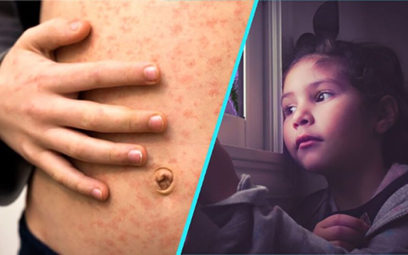 Rujeolă, gripă, vaccinare: Dr. Alexiu, despre dramele din spitalele din România