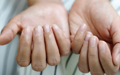 Unghiile „Terry” avertizează: Boli grave se ascund sub unghii, atenție la semne!