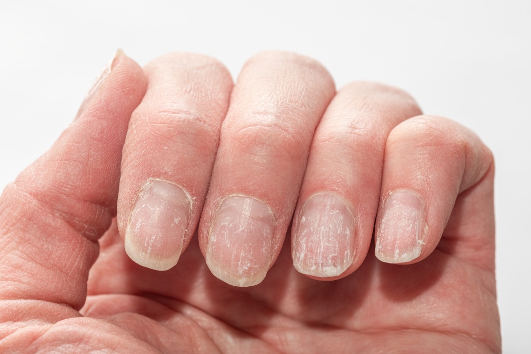 Unghiile tale te pot trăda: Boli grave de inimă, ficat sau rinichi