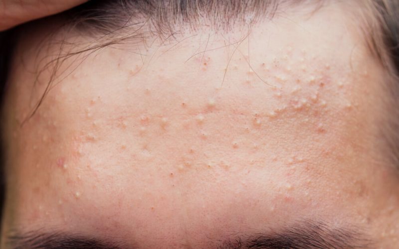 Acid salicilic: Protocol anti-acnee în 3 pași. Ghid complet (P)