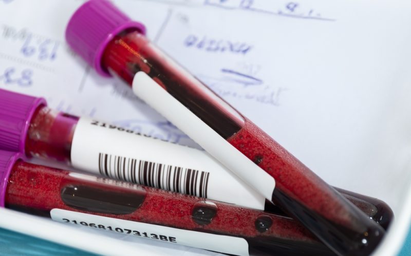 Ce analize de sânge arată dacă diabetul a distrus rinichii