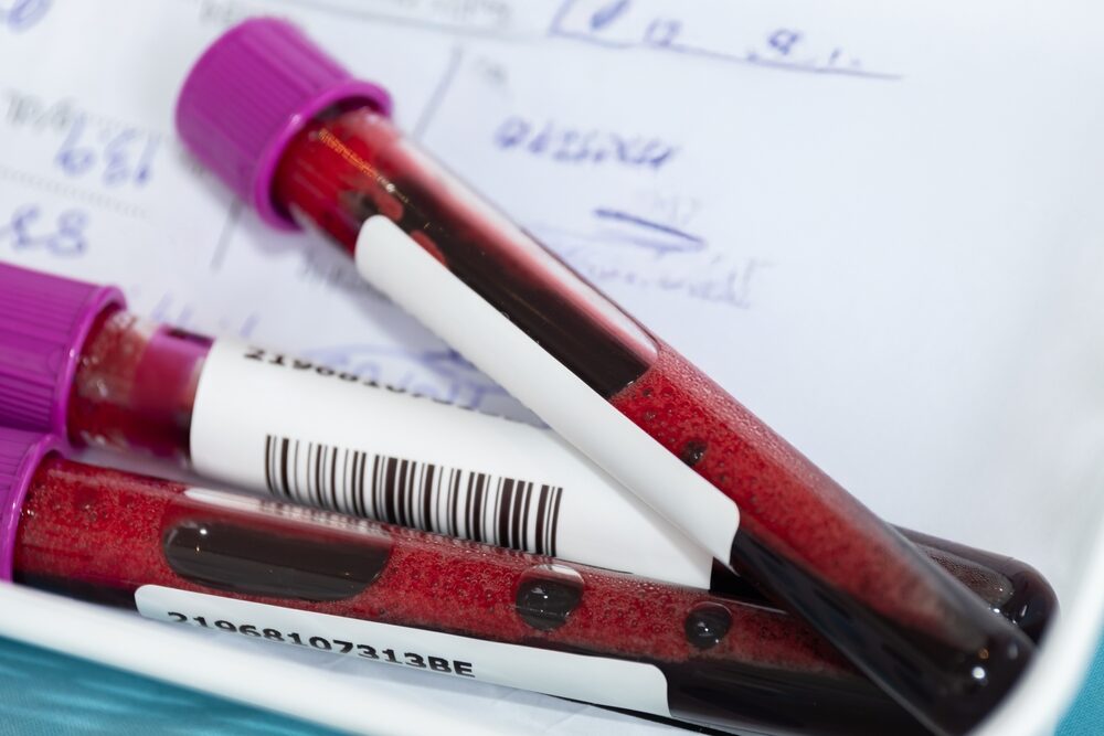 Ce analize de sânge arată dacă diabetul a distrus rinichii