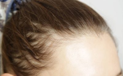 Slăbești și-ți cade părul? Injecțiile pentru slăbit, legate de alopecie