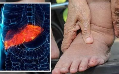 Picioarele anunță ficat gras. Gastroenterologul trage un semnal de alarmă