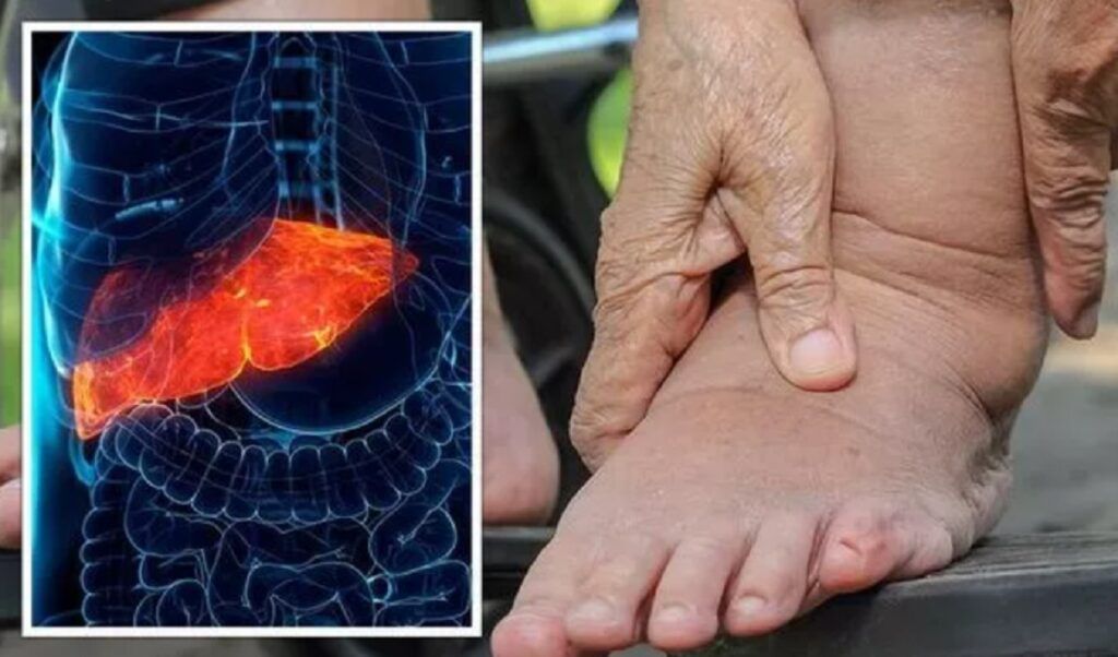 Picioarele anunță ficat gras. Gastroenterologul trage un semnal de alarmă